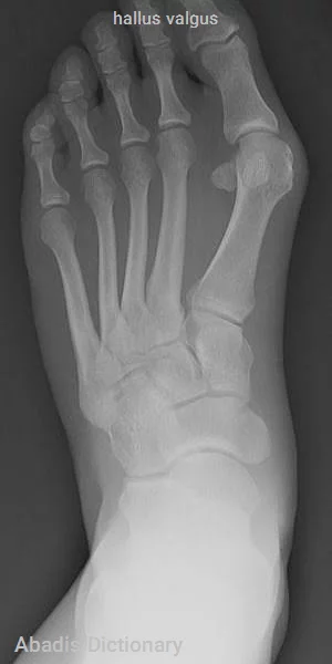 hallus valgus